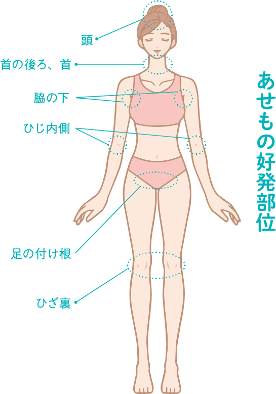 あせもの好発部位